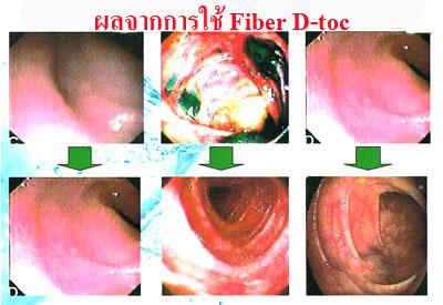 D-Toc Raspberry (ดีท็อค กลิ่นราสเบอร์รี่) ล้างสารพิษในลำไส้ โดยไม่ต้องสวนลำไส้
