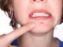 ACNE AWAY Laser